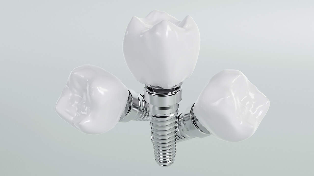 Dental implant costs