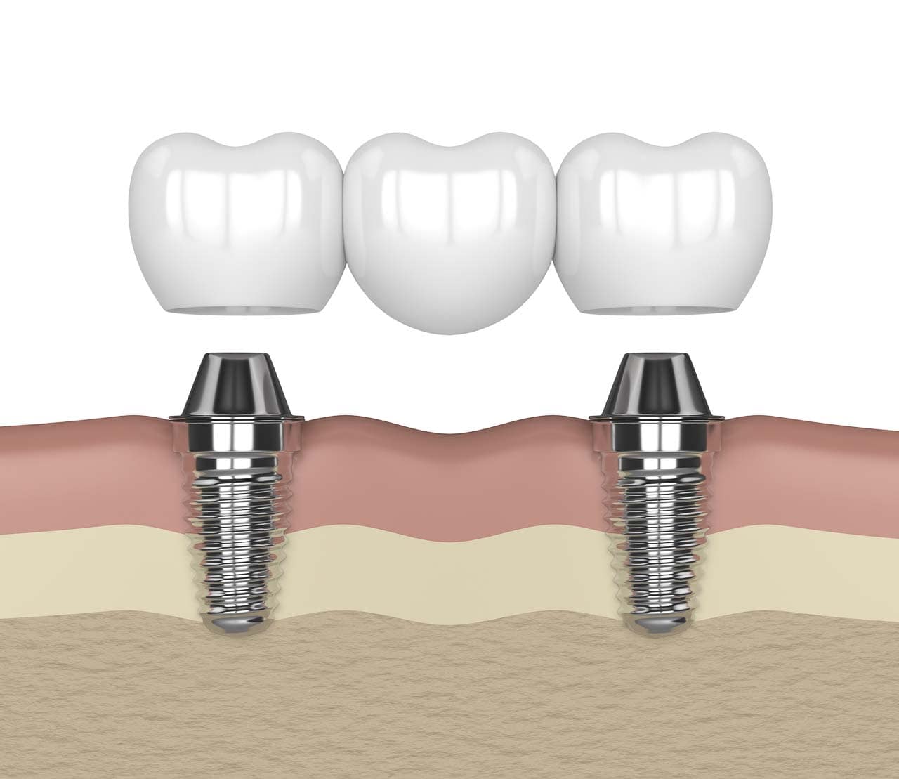 Stadium Dental - Implant Bridges