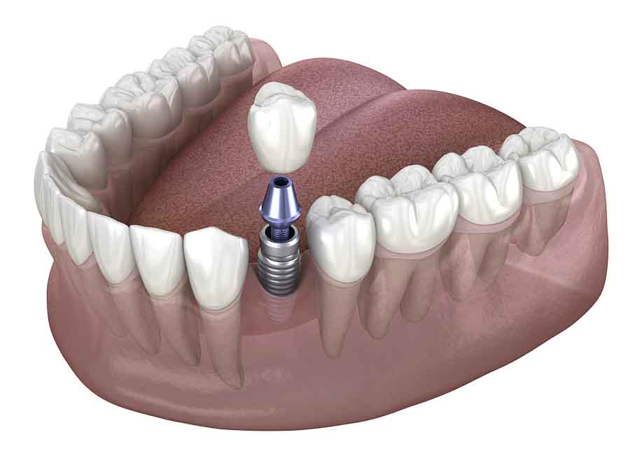 Stadium Dental smile gallery - Implants