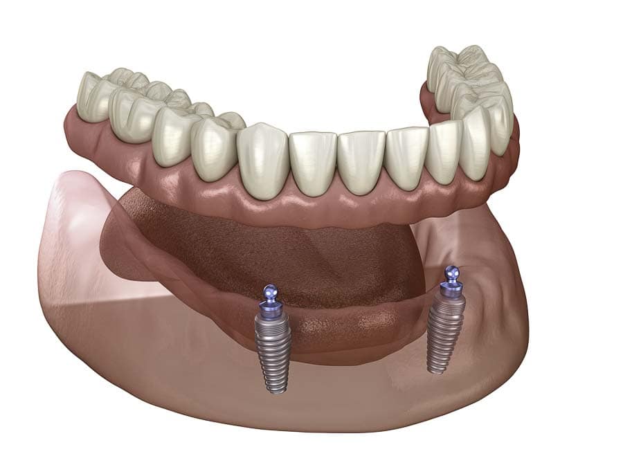 Stadium Dental - Implant Dentures
